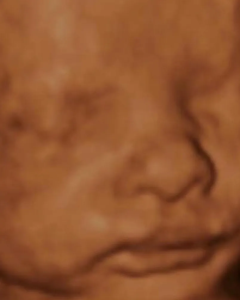 3D ultrasound scan